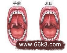 白喉的症状-民间特效白喉偏方