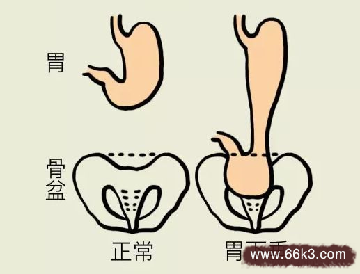 治疗胃下垂的中药秘方 胃下垂4种治疗方法