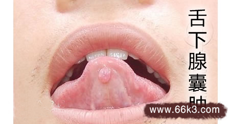 六神丸治舌下腺囊肿